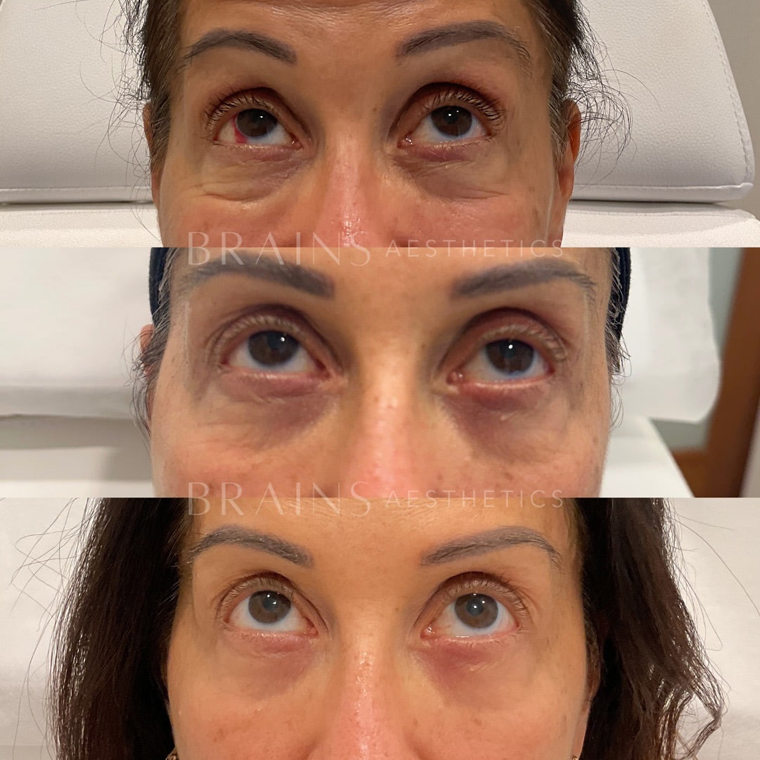 Rejuran Eye before and after results at Brains Aesthetics Williamstown