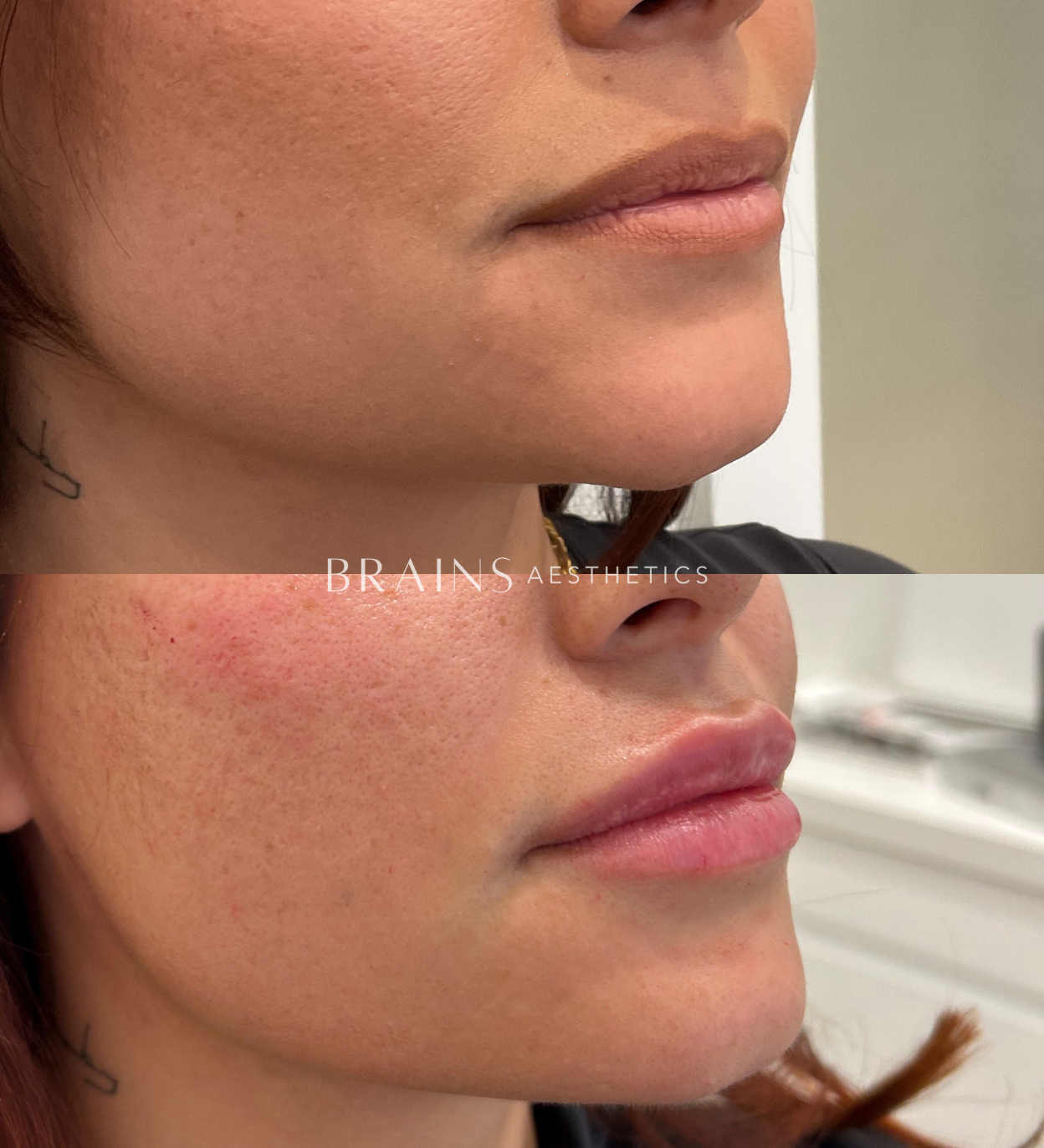 Anti-wrinkle, Dermal Fillers, Lip Fillers, Plump Lips, Rejuran, Skin Booster, Bio-remodelling. Experienced cosmetic injector in Melbourne West, Williamstown, Newport, Altona, Williamstown North