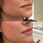 Anti-wrinkle, Dermal Fillers, Lip Fillers, Plump Lips, Rejuran, Skin Booster, Bio-remodelling. Experienced cosmetic injector in Melbourne West, Williamstown, Newport, Altona, Williamstown North
