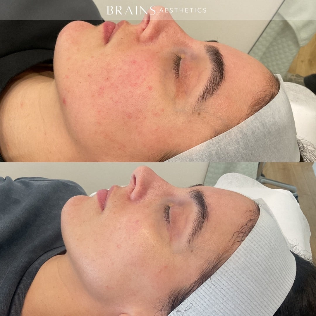 Before-and-after split comparison of a woman's face showing skin improvement, with the top panel showing redness/acne and the bottom panel showing clearer skin. The brand name 'BRAINS AESTHETICS' is visible at the top.