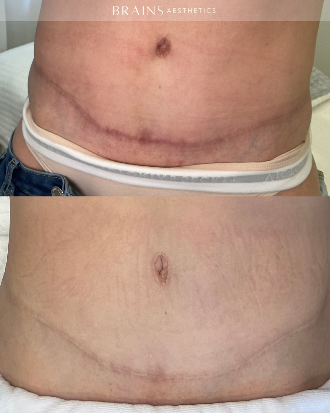 Before and after comparison of a cosmetic surgical scar reduction on a woman's lower abdomen, showing a prominent horizontal scar in the top photo and a significantly faded, healed scar in the bottom photo. The brand name 'BRAINS AESTHETICS' is watermarked at the top.