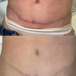 Before and after comparison of a cosmetic surgical scar reduction on a woman's lower abdomen, showing a prominent horizontal scar in the top photo and a significantly faded, healed scar in the bottom photo. The brand name 'BRAINS AESTHETICS' is watermarked at the top.