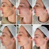 Even Tone Program – Dark Spots, Pigmentation & Uneven Tone