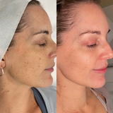 Even Tone Program – Dark Spots, Pigmentation & Uneven Tone