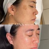 Even Tone Program – Dark Spots, Pigmentation & Uneven Tone