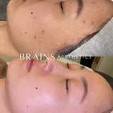 Even Tone Program – Dark Spots, Pigmentation & Uneven Tone